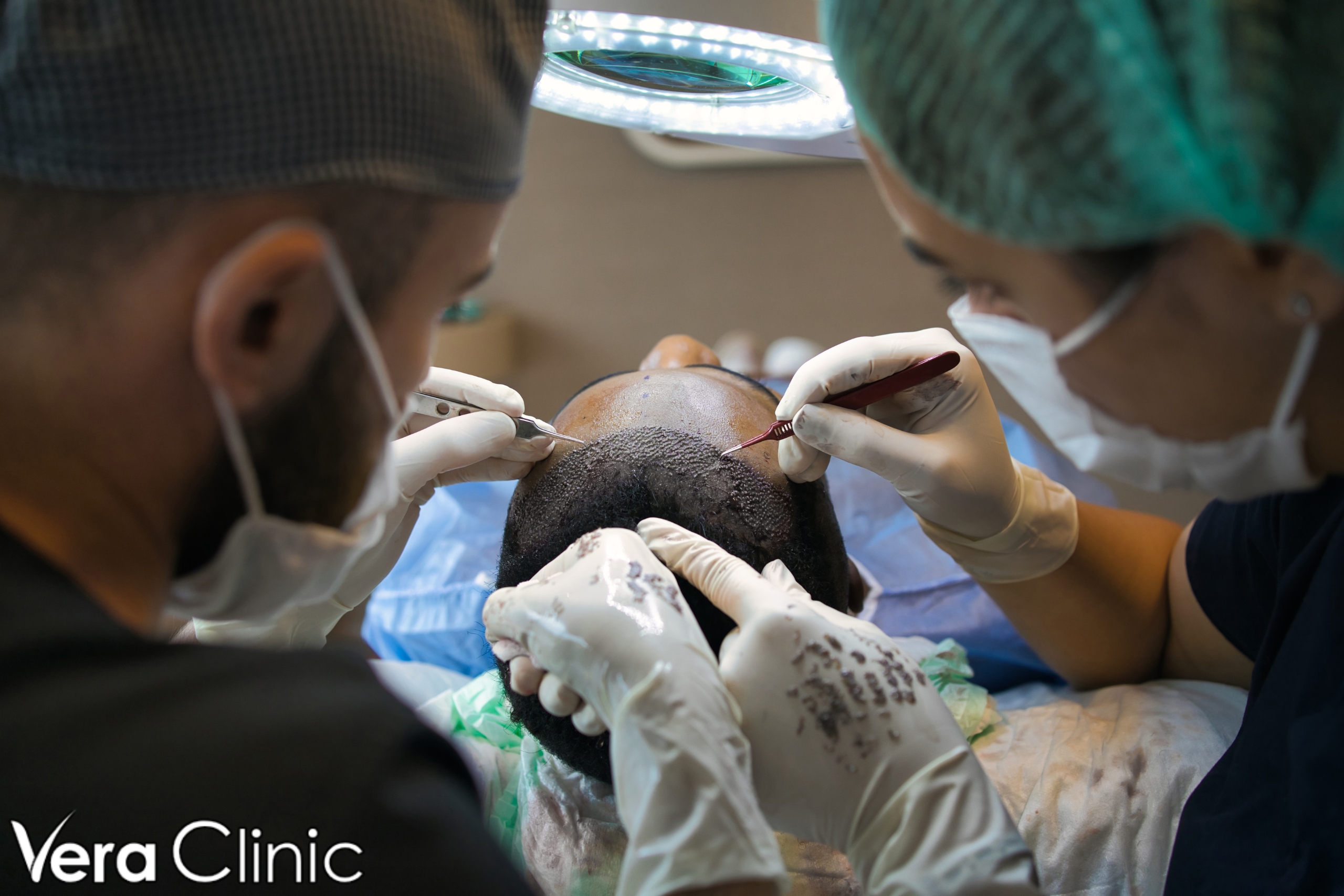 best hair transplant turkey